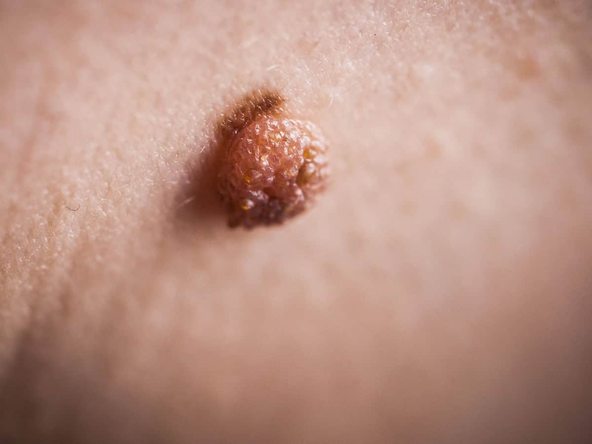 Close-up of a skin mole on human skin, showing detailed texture and irregular surface.