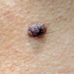 Dark irregular mole on skin with slight hair growth, close-up dermatology image.