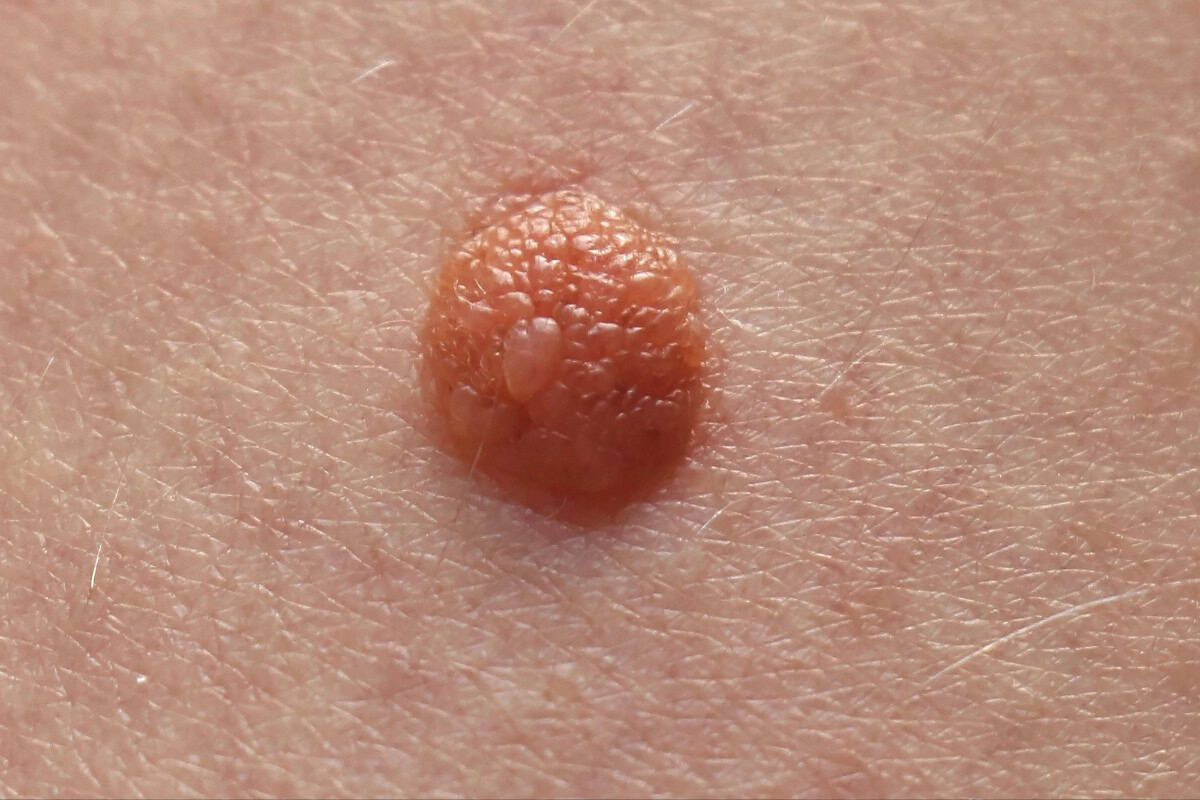 Mole removal on skin, close-up of skin mole, dermatology skin lesion, benign skin growth, mole on human skin.