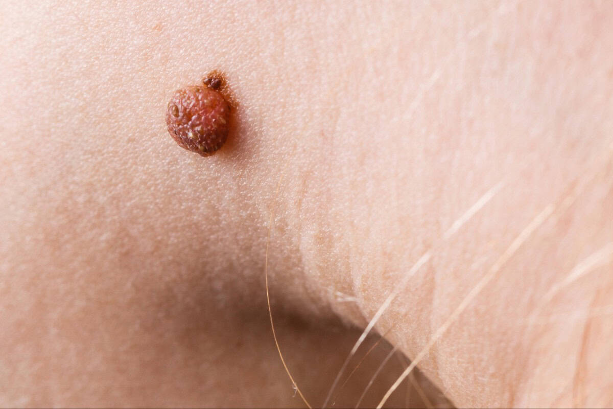 Freckle or mole on human skin, close-up image.