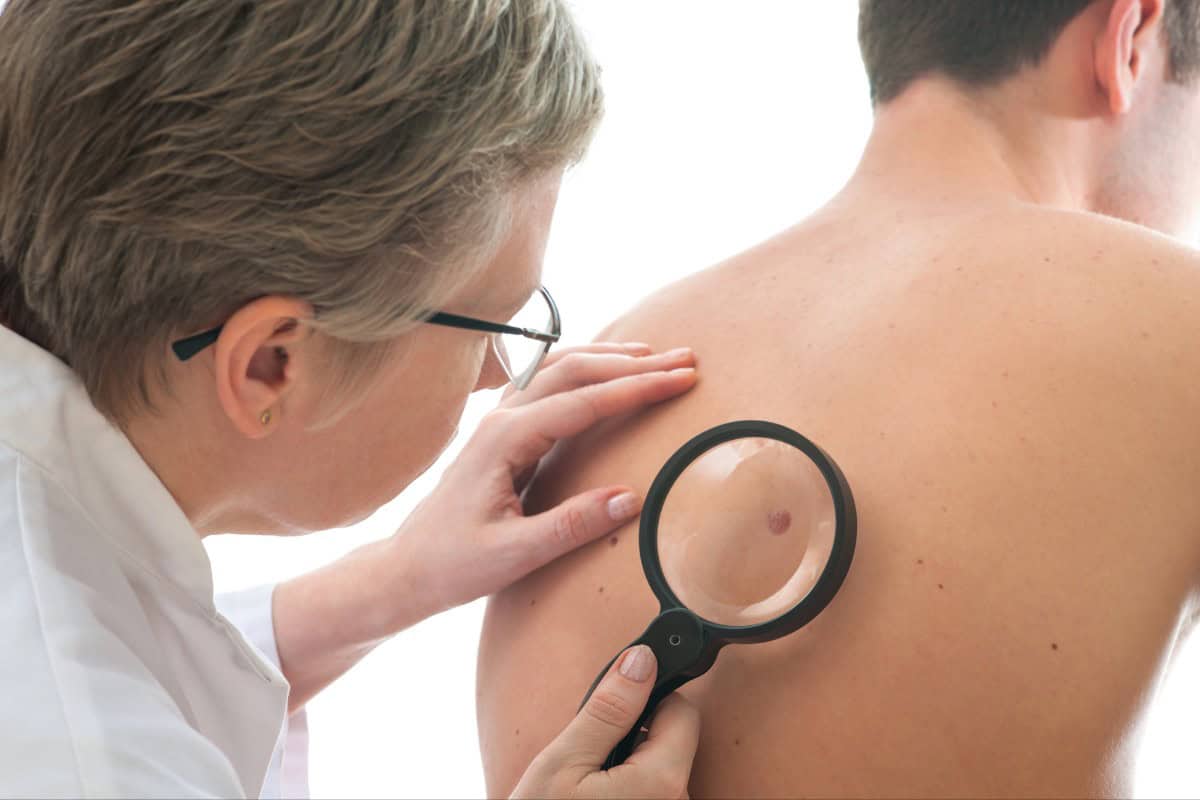 A dermatologist examining a patient's mole for skin cancer using a magnifying glass.
