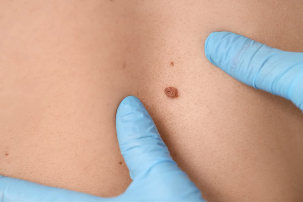 Mole removal or examination on human skin.