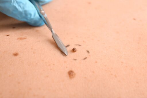 Dark mole removal procedure using a surgical tool on human skin.