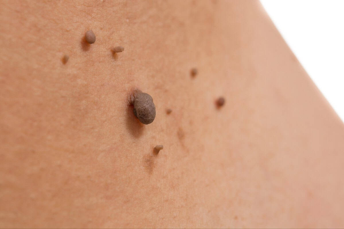 Black moles on human skin, close-up of mole skin features.
