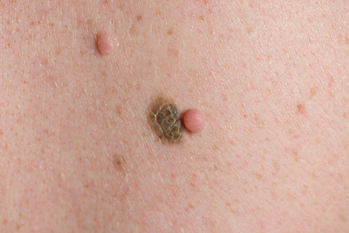 Close-up of skin with mole, wart, and skin tag, showing skin lesions and textures.